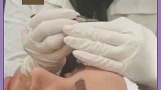 هزینه کاشت ابرو طبیعی در تهران و اصفهان چقدر است بررسی لک صورت