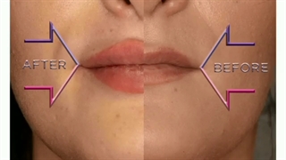 فیلم تزریق ژل لب طبیعی نچرال