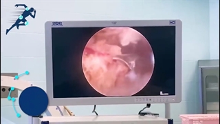 پارگی تاندون روتیتورکاف و درمان آن