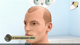 پیوند مو با خط رویش طبیعی