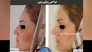 نمونه کارهای قبل و بعد از جراحی بینی