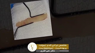 فیلم جراحی پیوند لثه هزمان برای 8 دندان در فک پایین