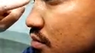 عمل بینی آسیایی گوشتی