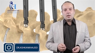 چرا در برخی از عمل ها از پیچ گذاری استفاده میشود؟