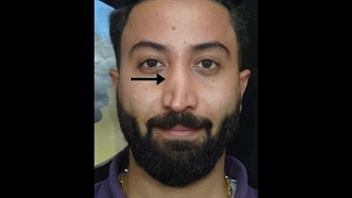 جراحی ترمیم بینی با پیوند غضروف دنده