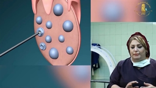 گرفتن تخمک در پروسه آی وی اف