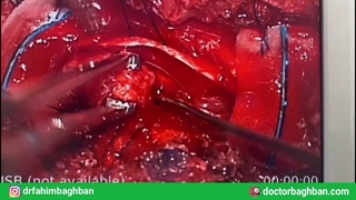 جراحی میکروسکوپیک تومور نخاع