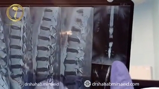 جراحی تنگی کانال نخاعی شدید و دیسک وسیع کمری