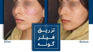 تزریق فیلر گونه