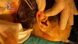 فیلم جراحی ضایعه گوشتی در محل سوراخ گوش