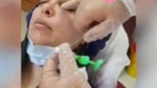 ماندگاری تزریق ژل در صورت چقدر است؟ مزوتراپی