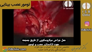 تومور عصب بینایی (گلیوم)