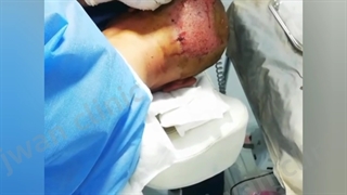 انجام کاشت مو تحت نظر خانم دکترهمتیان درکلینیک تخصصی جُوان