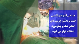 ابدومینوپلاستی