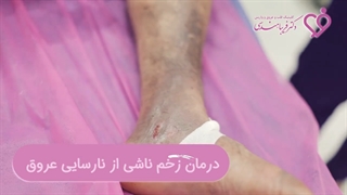 فیلم درمان زخم ناشی از نارسایی عروق در کلینیک زخم، طی 3 ماه