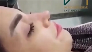 یک ماه پس از عمل بینی