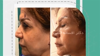 جای بخیه لیفت صورت بعد از چهارماه