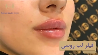 نمونه واقعی تزریق ژل لب مدل روسی بدون عوارض