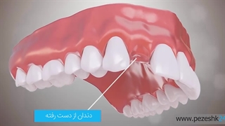 ایمپلنت فوری دندان