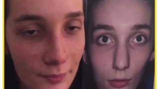 رضایت از عمل بینی