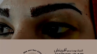 نمونه کاشت ابرو در بهترین کلینیک تهران | کلینیک آفرینش