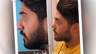 عمل بینی مردانه