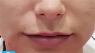 نمونه تزریق های ژل لب توسط دکتر آذر مسرور| کالج cntaa