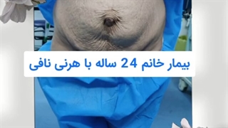 جراحی فتق نافی خانم 24 ساله