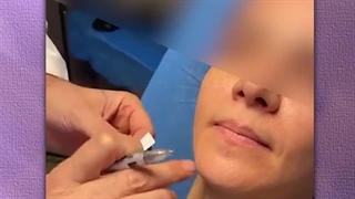 فیلم تزریق پروفایلو به صورت و گردن توسط دکتر رفیع | جراح پلاستیک تهران