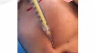 تفاوت تزریق چربی به روش نانوفت و svf چیست؟ جراحی بینی