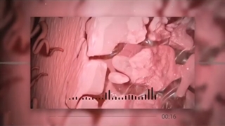 رضایت بیمار از چسبندگی رحم و اندومتریوز با لاپاراسکوپی