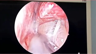 فیلم بدون سانسور جراحی پولیپ بینی