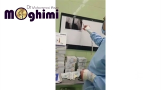 عمل جراحی پروتز گذاری مفصل ران در خانم 82 ساله