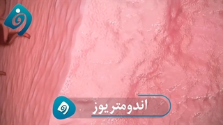 علائم آندومتریوز| دکتر فاطمه فیروزی روکش دندان