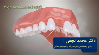 جراحی ایمپلنت دندان