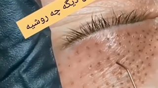 فیلم رفع افتادگی پلک با پلکسر چشم