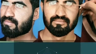 فیلم عمل بینی استخوانی مردانه قوزدار