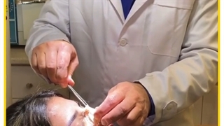 باز کردن کچ بینی