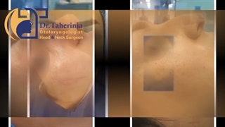 جراحی زیبایی بینی در اتاق عمل