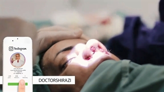 فیلم کامل و بدون سانسور جراحی بینی گوشتی