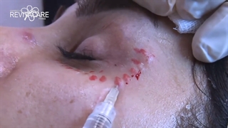 آموزش تزریق رویتاکر