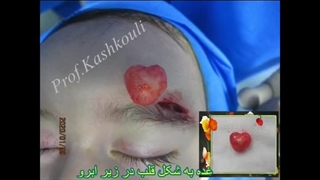برداشتن غده از زیر ابرو در کودک | پروفسور کشکولی | جراح پلک تهران