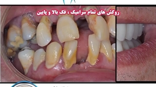 روکش سرامیک فک بالا