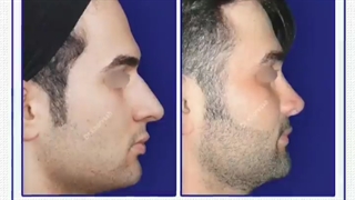 جراحی زیبایی بینی | دکتر خوروش