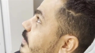 یک ماه و نیم پس از گذشت بینی آسیب دیده و گوشتی