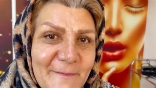 دو هفته پس از جراحی زیبایی پلک با بی حسی موضعی