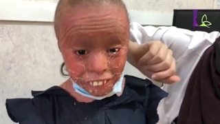 فیلم روند درمان طاهره، کودک مبتلا به ایکتیوز