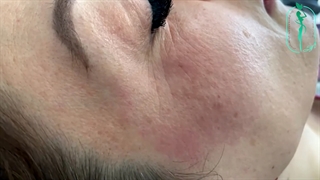 تزریق ژل اطراف و زیر چشم و کانتورینگ گونه
