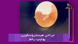 فیلم کامل و بدون سانسور عمل پولیپ رحم