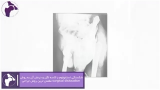شکستگی استابولوم یا کاسه لگن و درمان آن مطمئن ترین روش جراحی